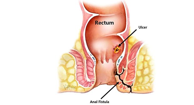 Fistula Treatment