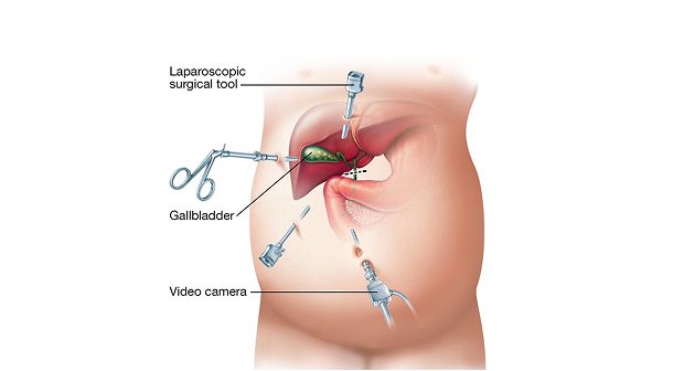 Gall Bladder Surgery