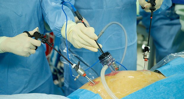 Laparoscopic Surgery