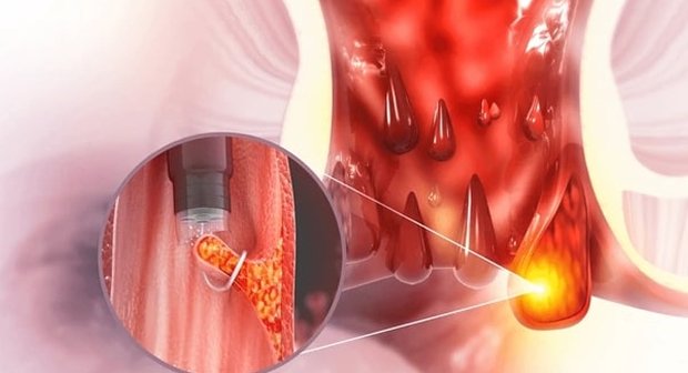 Laser Piles Treatment