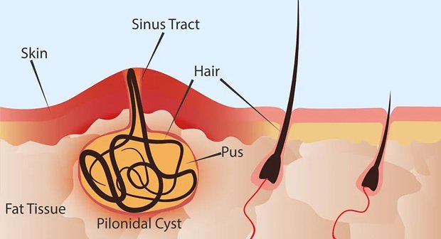 Pilonidal Sinus